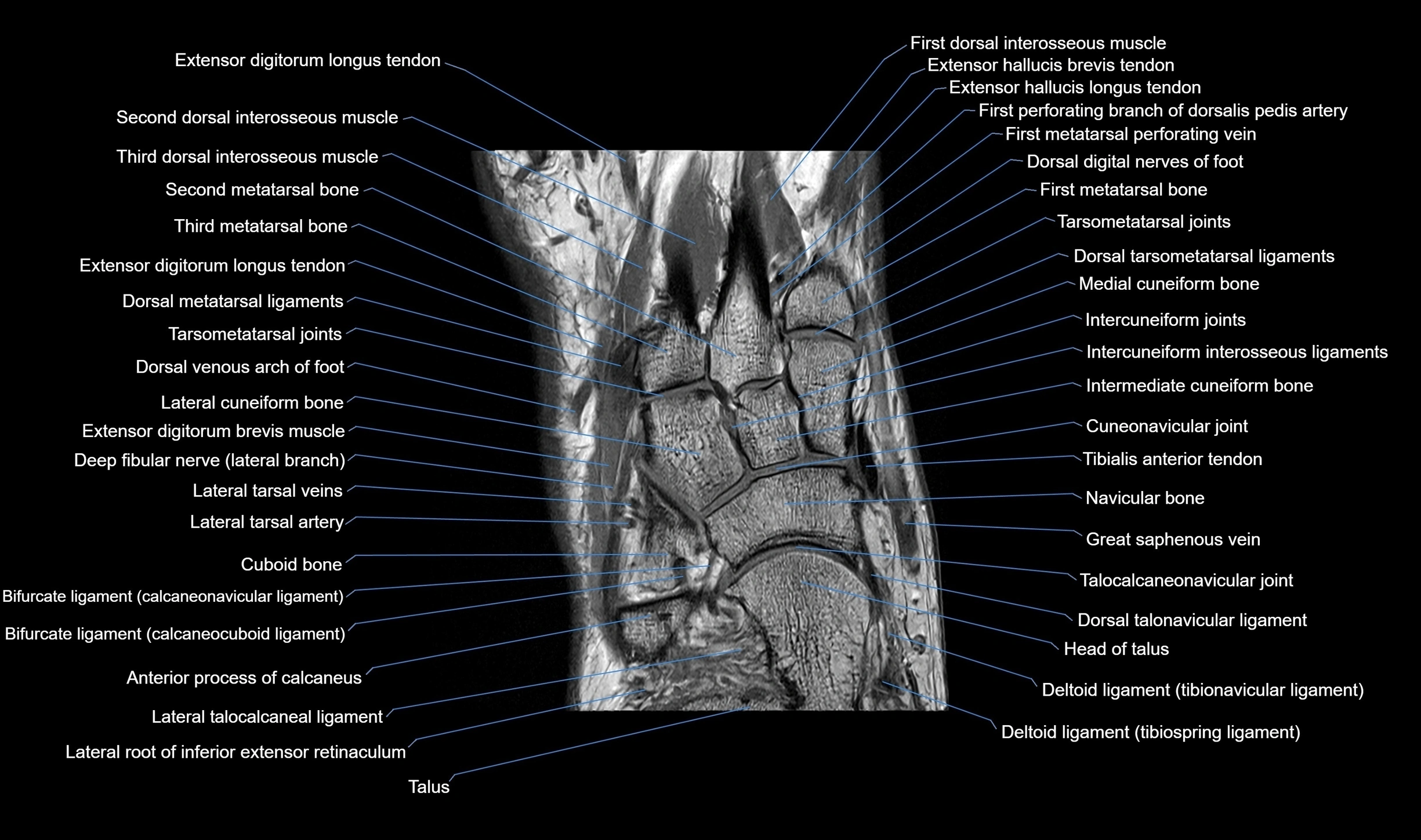 MRI mid foot coronal ligaments cross sectional anatomy 3T  radiology  image-img-00001-00017.webp